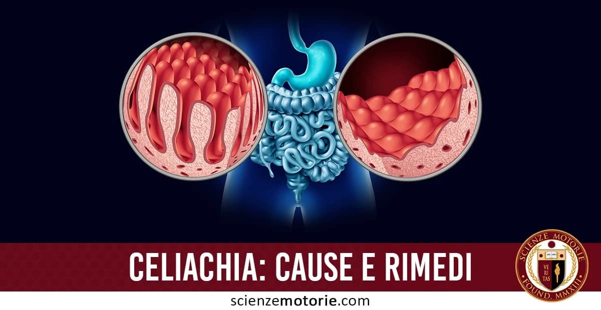 llustrazione che confronta mucosa intestinale sana e danneggiata dalla celiachia, con intestino al centro e scritta "CELIACHIA: CAUSE E RIMEDI", in basso a destra appare il logo di Scienze Motorie