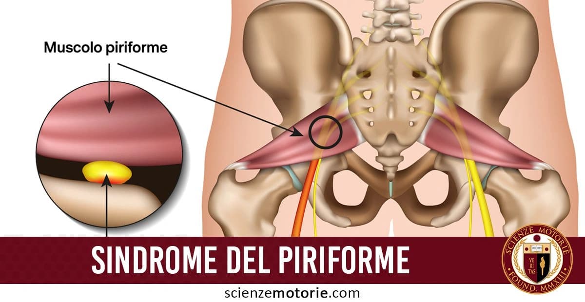 L'immagine rappresenta l'anatomia del bacino, con particolare attenzione al muscolo piriforme e alla sindrome che lo riguarda. Viene evidenziato un diagramma circolare che illustra la sindrome del piriforme, un disturbo muscolare che può causare dolore nella zona lombare e nelle gambe. in basso a destra è presente il logo di Scienze Motorie