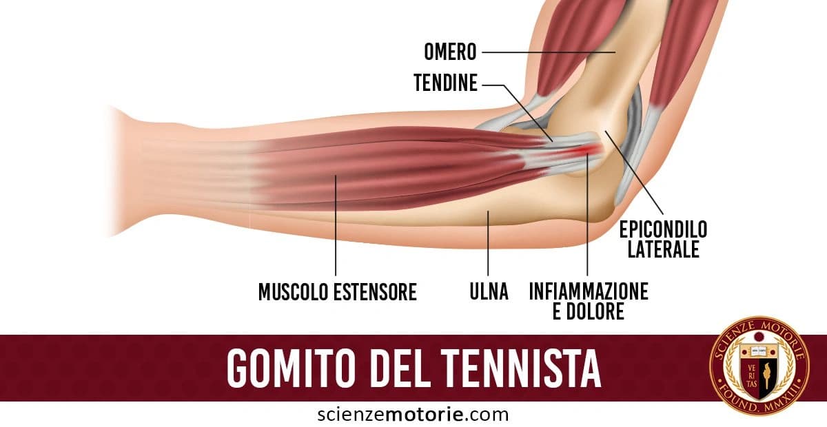 Diagramma anatomico del "gomito del tennista" che mostra l'infiammazione e il dolore nella zona dell'epicondilo laterale, con indicazione di ossa e muscoli coinvolti, come l'omero, l'ulna, il tendine e il muscolo estensore. in basse a destra è presente il logo di ScienzeMotorie.com