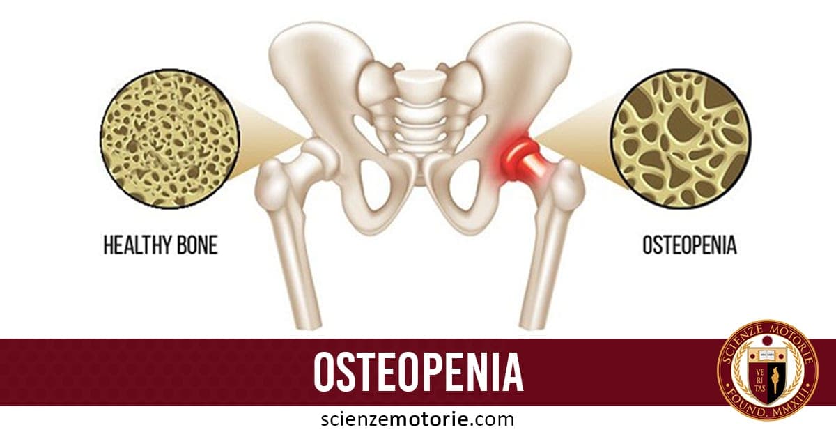Diagramma che confronta un osso sano e uno con osteopenia, con ingrandimenti della struttura ossea e immagine del bacino umano evidenziata, testo "OSTEOPENIA" e logo Scienze Motorie