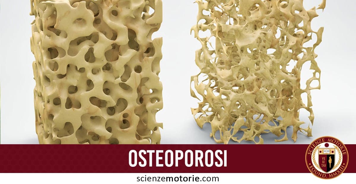 L’immagine mostra due sezioni ossee a confronto: a sinistra un osso sano, compatto e denso; a destra uno con osteoporosi, più poroso e fragile. In basso, una banda rossa con la scritta “OSTEOPOROSI” e il logo di Scienze Motorie
