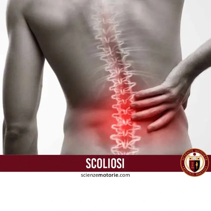 L’immagine mostra una persona di spalle con una mano sulla parte bassa della schiena, evidenziando dolore lombare. La colonna vertebrale, evidenziata graficamente, presenta una curvatura anomala tipica della scoliosi. Il rossore nella zona lombare indica infiammazione o tensione. Il testo “SCOLIOSI” e l’indirizzo scienzemotorie.com